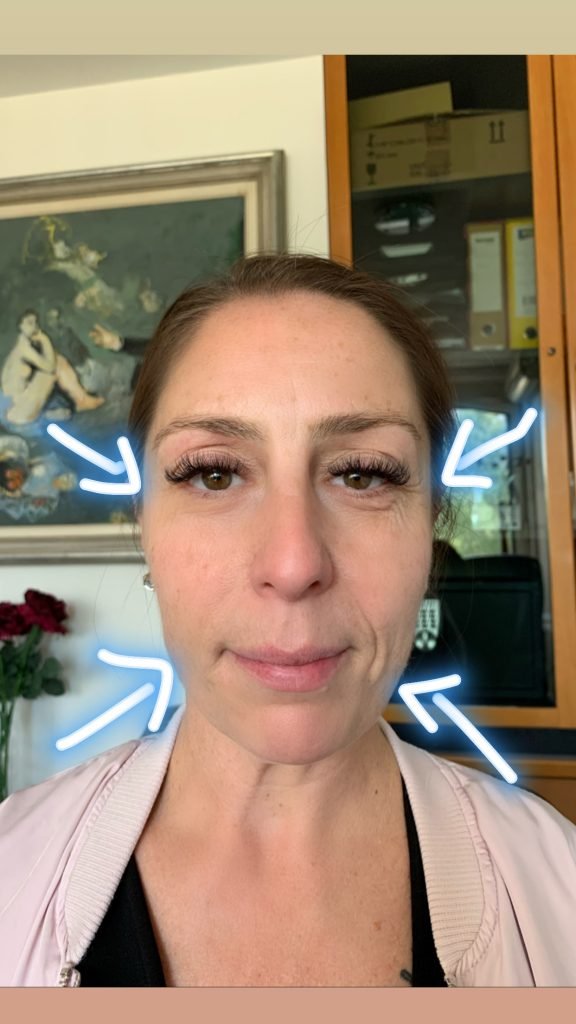 HIFU-PRIJE-I-POSLIJE-2-576x1024