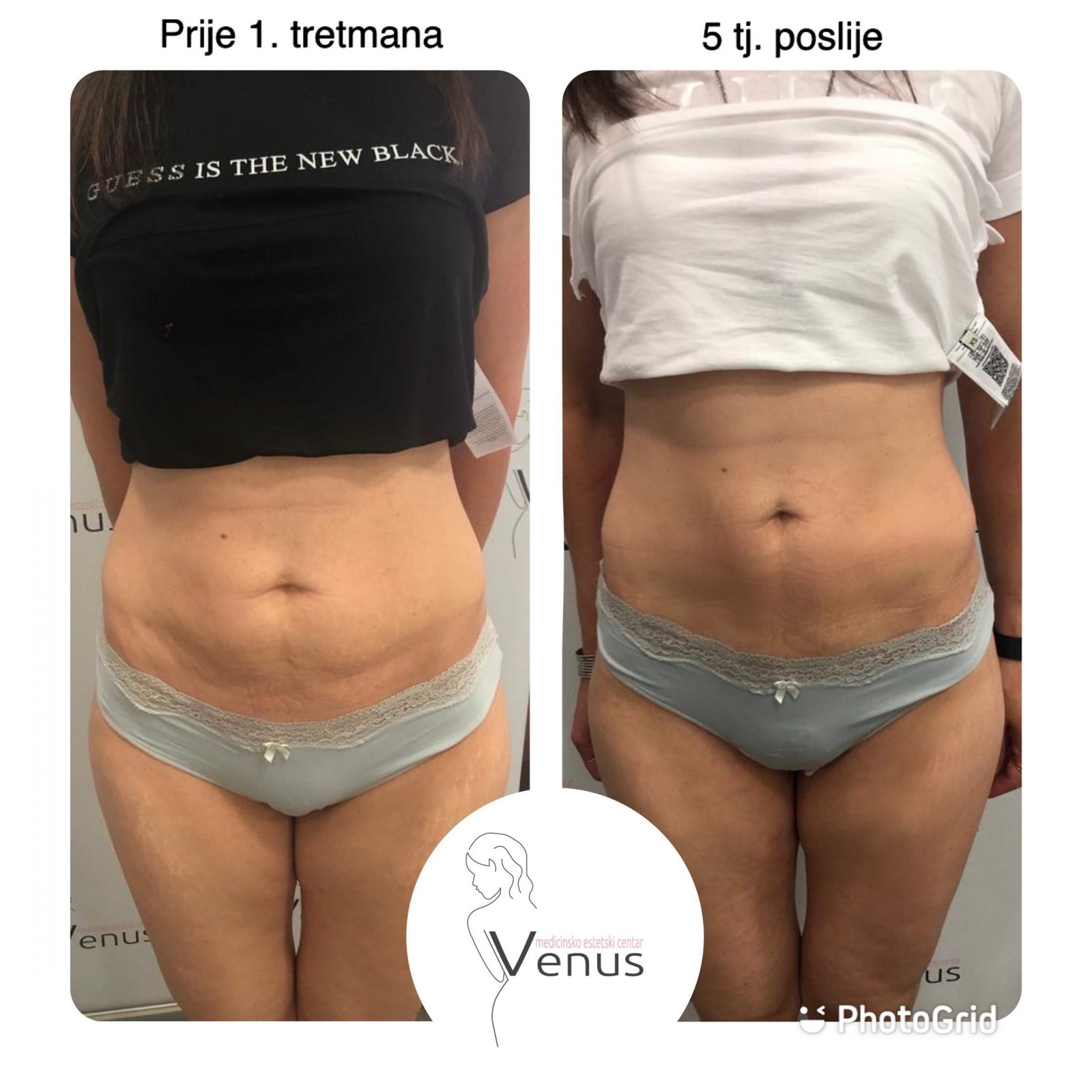 HIFU-TIJELO-scaled (1)