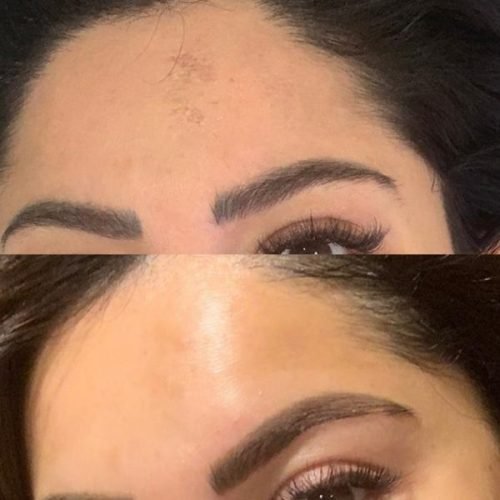 KEMIJSKI-PILING-600x600 (1)