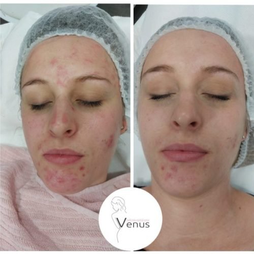 KEMISJKI-PILING-LICE-scaled-600x599 (1)